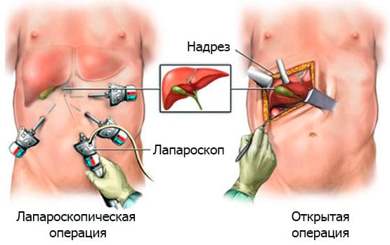 лапароскопия и лапаротомия