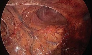 Методика TEP (Total Extraperitoneal Approach)