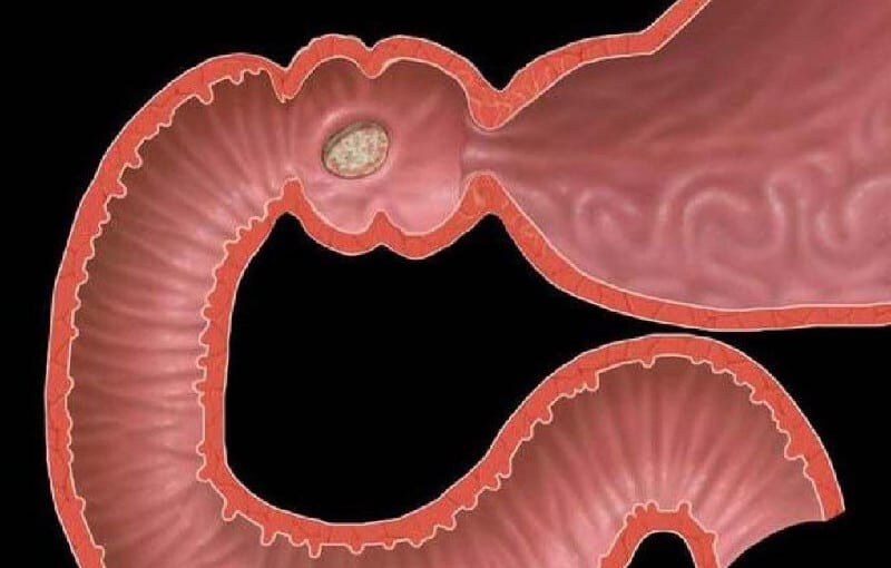 Причины язвы желудка и язва перстной кишки - АМО