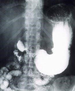 стеноз желудка рентген