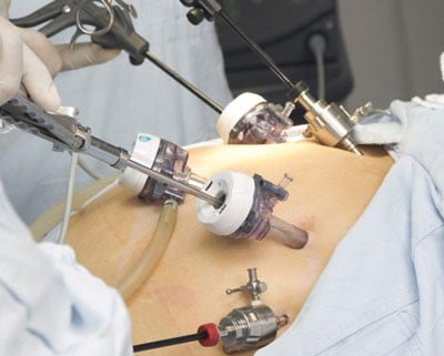 Лапароскопическая резекция желудка (вид передней брюшной стенки после установки троакаров) и инструментов
