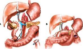 Гастропанкреатодуоденальная резекция поджелудочной железы