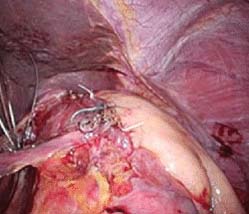 Лапароскопическая кардиомиотомия
