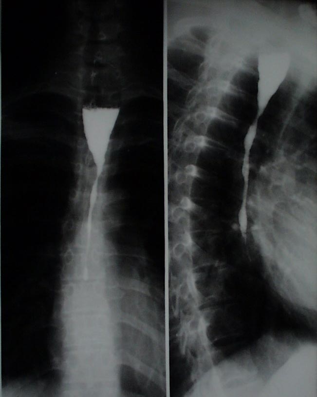 Рентгенологическая картина протяженной ожоговой стриктуры пищевода 3-4 ст.