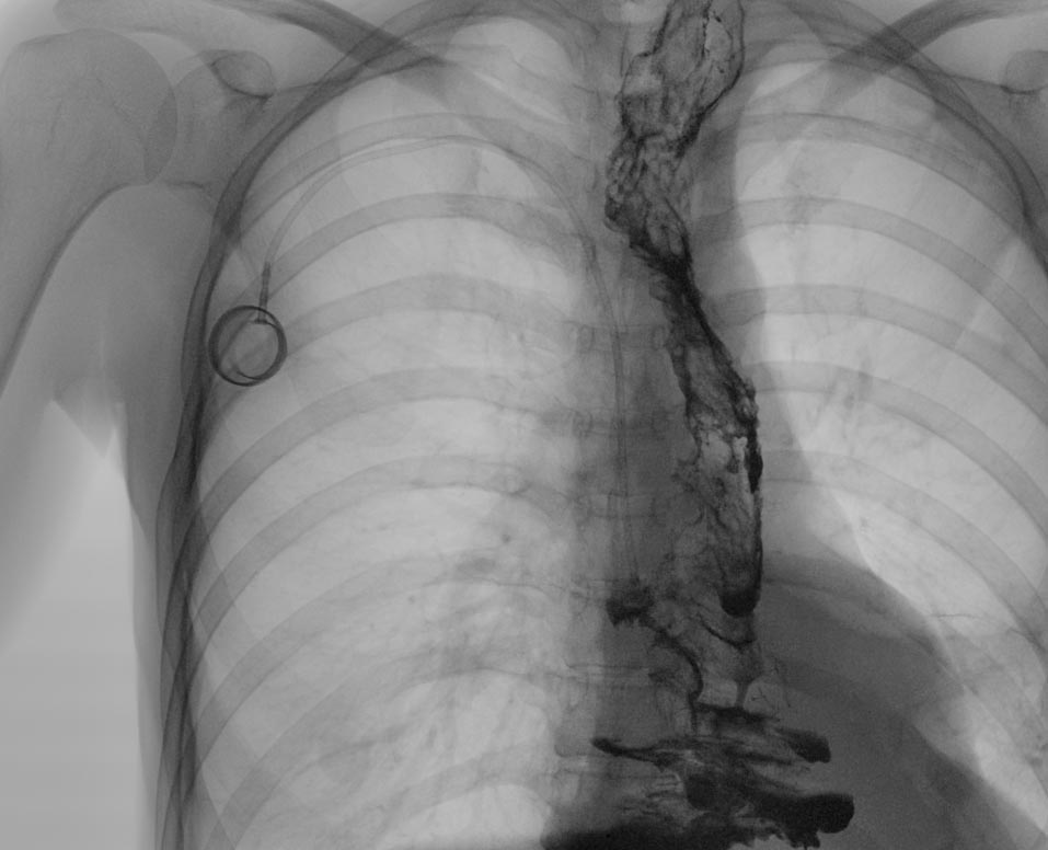 Рентгенологическая картина толстокишечного трансплантата