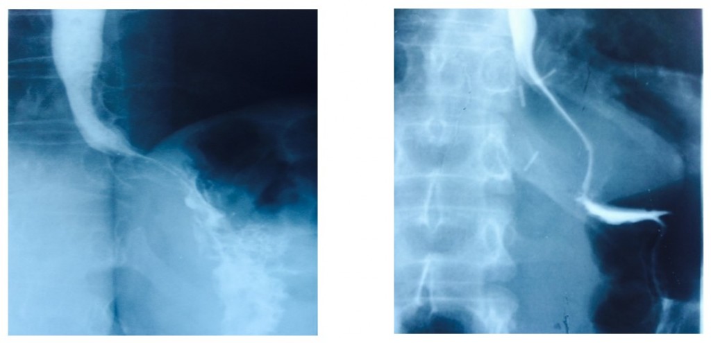 Рентгенологическое исследование с контрастом после фундопликации (норма)